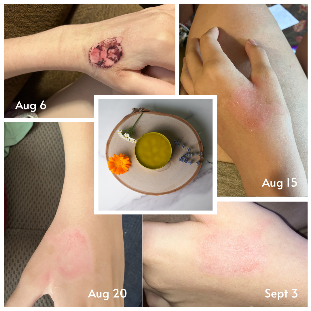 Burn & Bite Botanical Balm