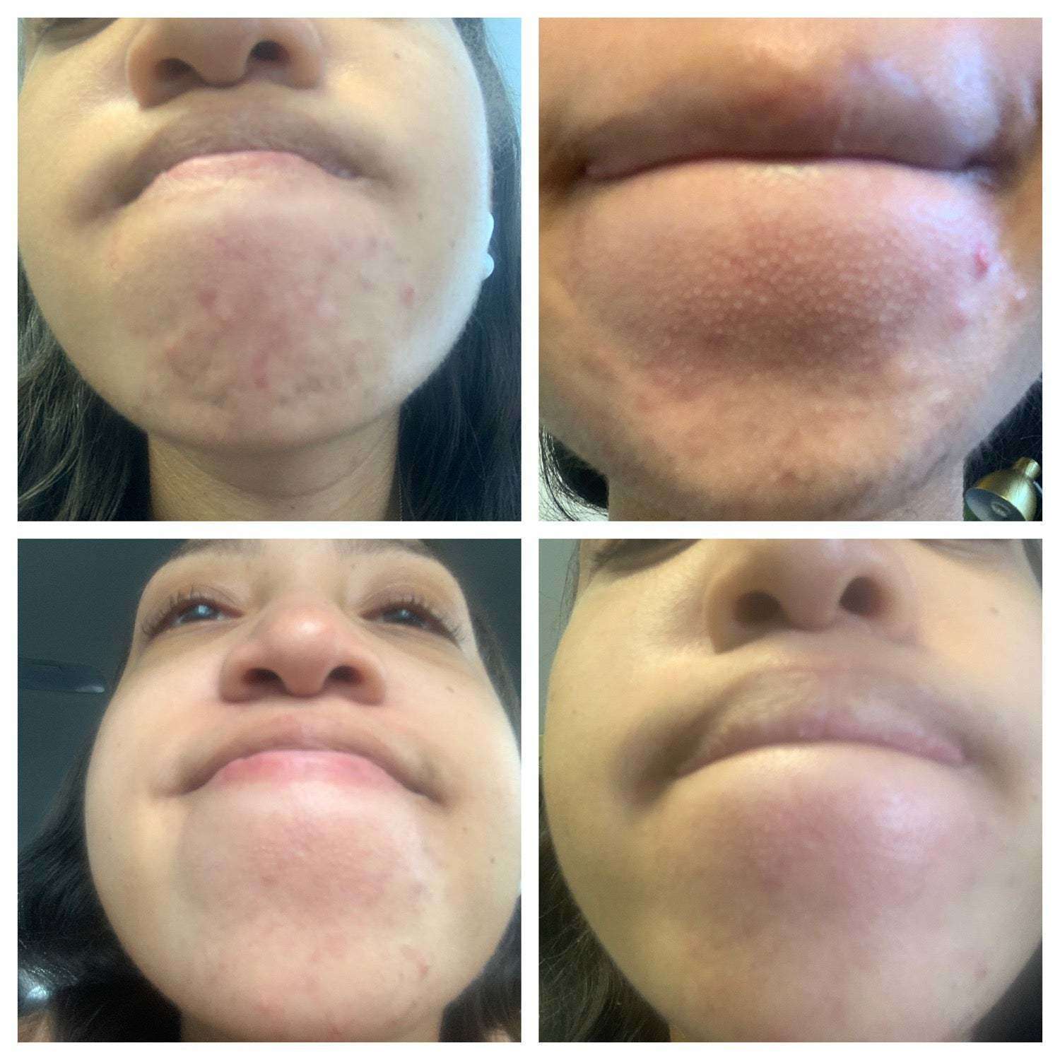 BalanC Toner | Pregnancy-safe Acne Toner-zoom-4