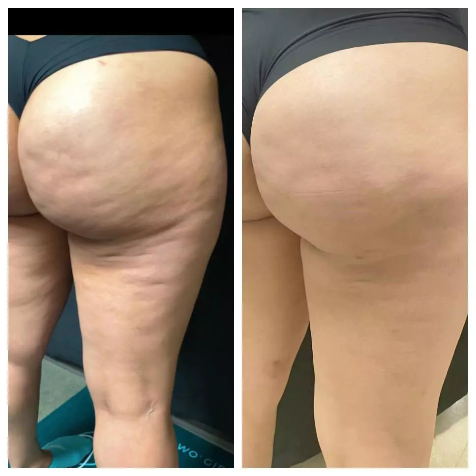 Cheek Chic Cellulite Gel-2